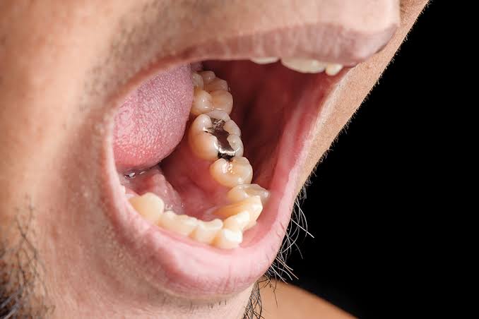 Suboxone Tooth Decay Lawsuit