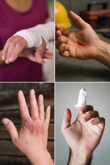 Hand, Wrist, and Finger Injury Settlement Amounts