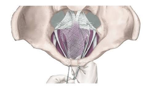 Vaginal Mesh Lawsuit